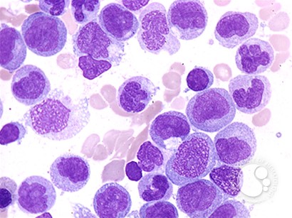 Acute Lymphocytic Leukeamia Res-Net Classifier Banner Image